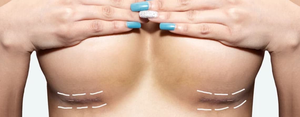 Bruststraffung durch Autoaugmentation: Eine natürliche Alternative zu Silikonimplantaten