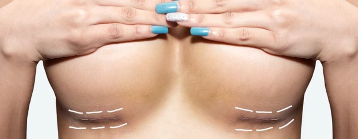 Bruststraffung durch Autoaugmentation: Eine natürliche Alternative zu Silikonimplantaten