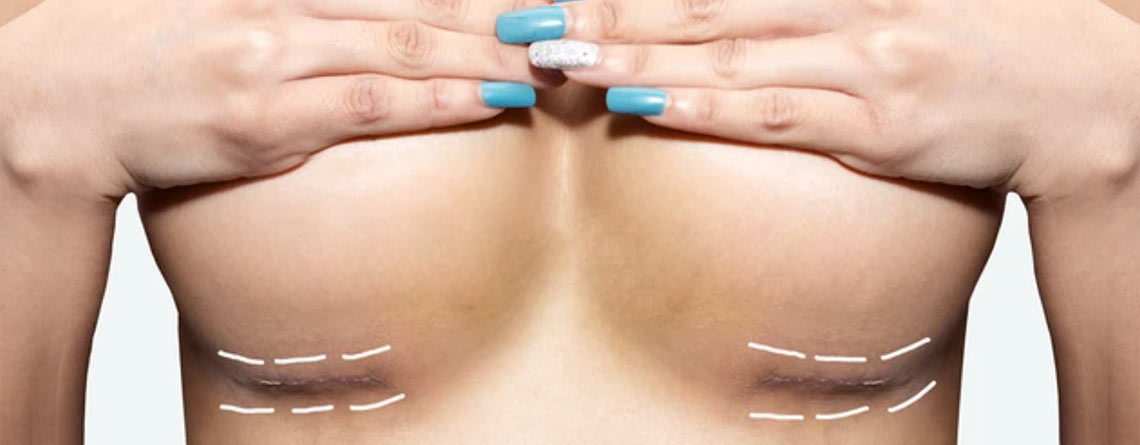 Bruststraffung durch Autoaugmentation: Eine natürliche Alternative zu Silikonimplantaten
